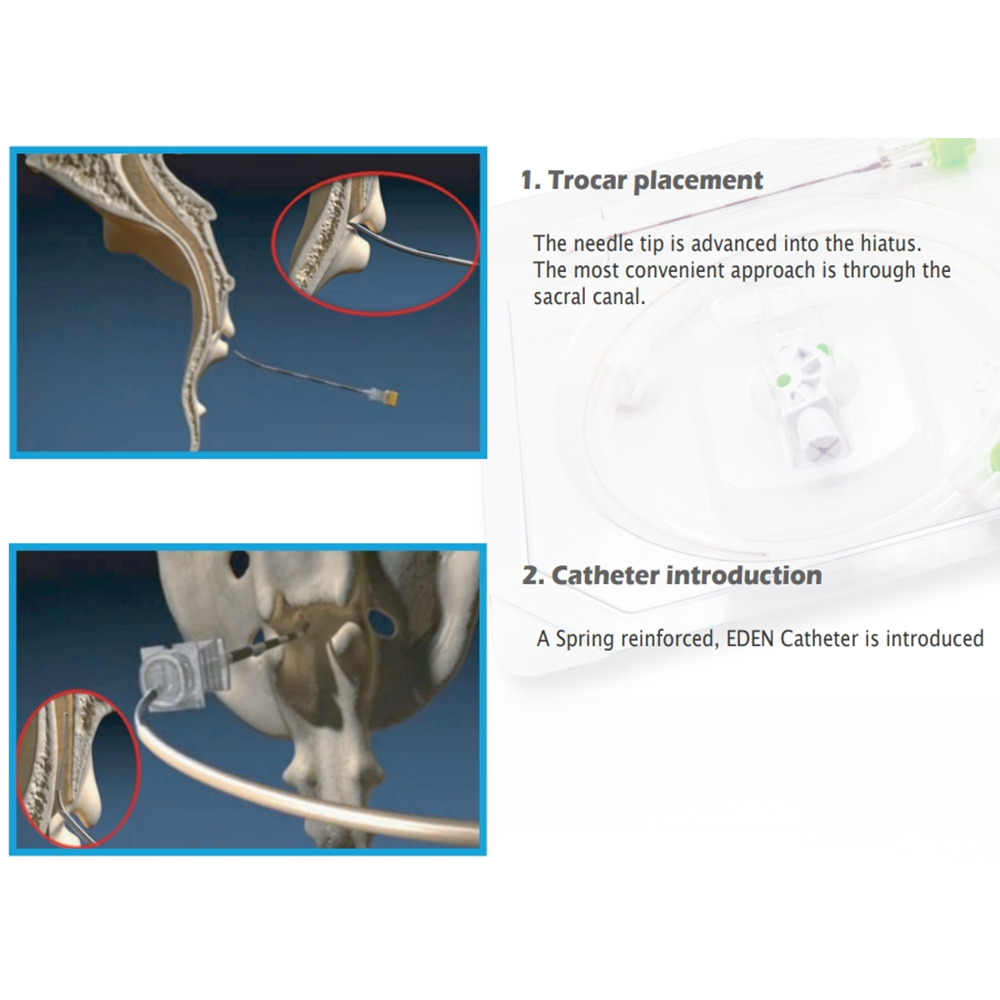 Epidural Catheter